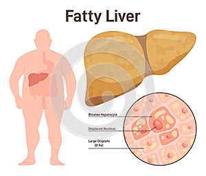 Fatty liver disease, NAFLD. Extra fat in the liver. Overweight person