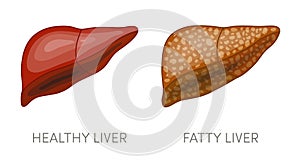 Fatty liver disease