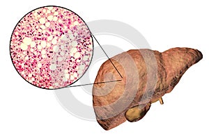 Fatty liver, liver steatosis