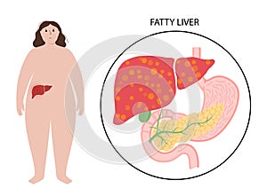 Liver disease concept photo