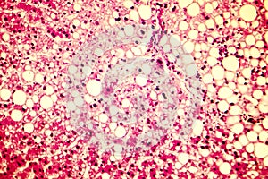 Light micrograph of a fatty liver photo