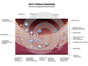 Fatty streak formation in the artery