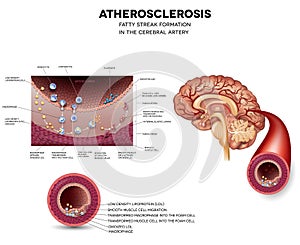 Fatty streak formation in the brain artery photo