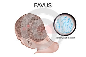 Favus. the causative agent of favus photo