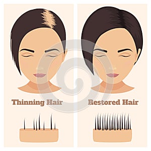 Feale pattern alopecia set. Medical educational poster.