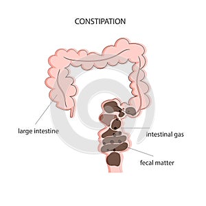 Fecal obstruction and gas accumulation in the intestines