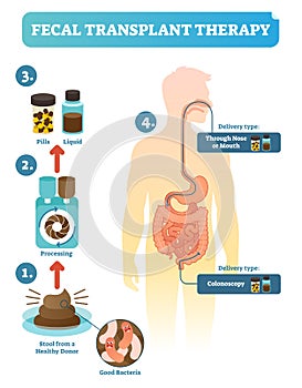 Fecal transplant therapy, procedure steps diagram, vector illustration. Renewing human digestive microflora.