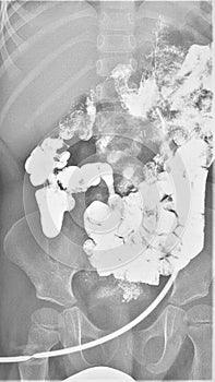 Feeding gtube contrast control xray exam gastrointestine