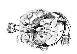 Feeling the fetus with fingers in the old book Placenta Praevia, by A. Auvard, 1886, Paris