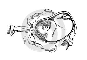 Feeling the fetus with fingers in the old book Placenta Praevia, by A. Auvard, 1886, Paris