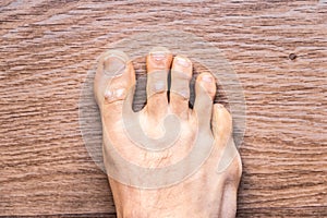 Feet of barefoot man with psoriasis dermatitis on his fingers