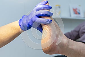 Feet with dry skin, cracked heels, podiatrist examining patient