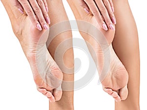 Feet with dry skin before and after treatment.