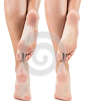 Feet with dry skin before and after treatment.