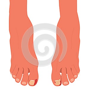 Feet with ingrown toenails.Disease, fungus or inflammation in fingernails. Legs problem area with pus and blood.Right pedicure,bod