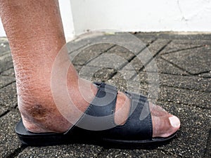 The feet of man with diabetes, dull and swollen. Due to the toxicity of diabetes photo