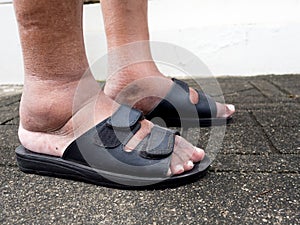 The feet of man with diabetes, dull and swollen. Due to the toxicity of diabetes photo