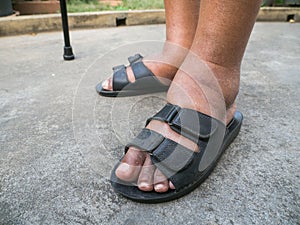 The feet of man with diabetes, dull and swollen. Due to the toxicity of diabetes. Foot swelling caused by drinking water.