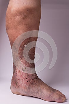 Feet old woman patient with varices on a white background photo
