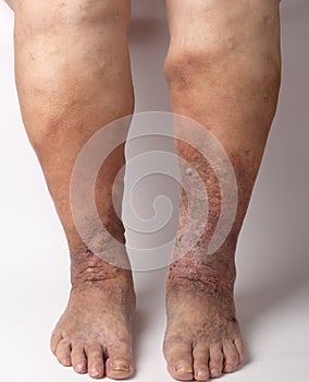 Feet old woman patient with varices on a white background photo