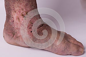 Feet old woman patient with varices on a white background