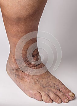 Feet old woman patient with varices on a white background