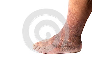 Feet old woman patient with varices on a white background