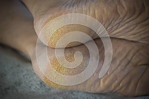 Feet of a patient with diabetes. Diabetic foot. Hyperkeratosis and cracks in the skin of the foot. Close-up