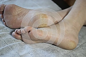 Feet of a patient with diabetes. Diabetic foot. Hyperkeratosis and cracks in the skin of the foot. Close-up photo