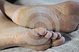 Feet of a patient with diabetes. Diabetic foot. Hyperkeratosis and cracks in the skin of the foot. Close-up photo