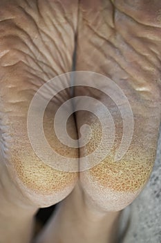 Feet of a patient with diabetes. Diabetic foot. Hyperkeratosis and cracks in the skin of the foot. Close-up photo