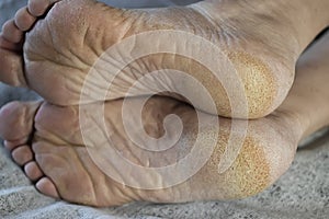 Feet of a patient with diabetes. Diabetic foot. Hyperkeratosis and cracks in the skin of the foot. Close-up photo