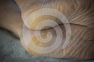 Feet of a patient with diabetes. Diabetic foot. Hyperkeratosis and cracks in the skin of the foot. Close-up photo