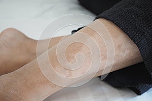 feet with vitiligo skin condition.