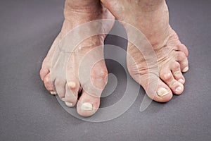 Feet Of Woman Deformed From Rheumatoid Arthritis photo