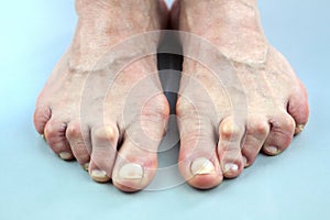 Feet Of Woman Deformed From Rheumatoid Arthritis photo
