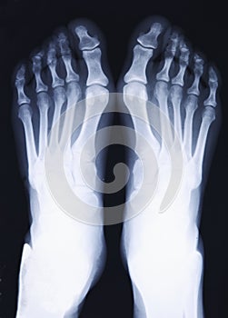 Feet xray