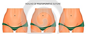 The female abdomen. healing joint after appendectomy