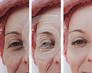Female adult facial wrinkles rejuvenation mature patient difference before and after procedures, arrow