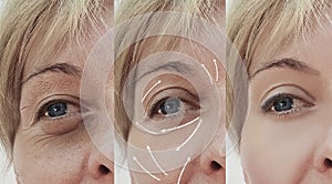 Female adult facial wrinkles rejuvenation treatment mature patient difference before and after cosmetic procedures, arrow