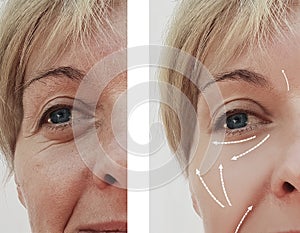 Female adult facial wrinkles rejuvenation treatment mature patient difference before and after procedures, arrow