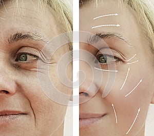 Female adult facial wrinkles removal rejuvenation filler mature patient difference before and after procedures, arrow
