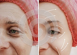 Female adult facial wrinkles treatment mature patient difference before and after cosmetic procedures, arrow