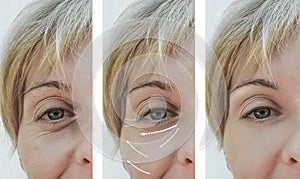 Female adult wrinkles removal rejuvenation filler patient difference before and after procedures, arrow