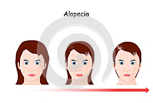 Female alopecia development