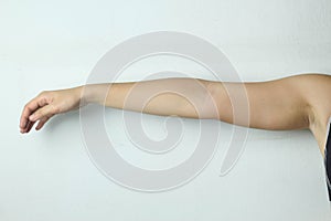 Female Arm with cellulite