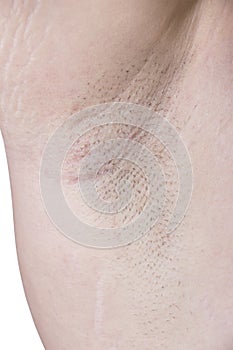 Female Armpit With Irritation photo