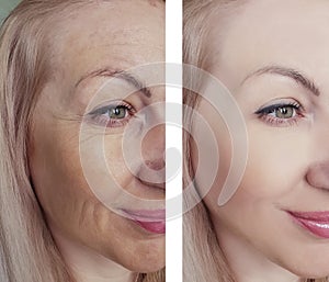 Female eye beauty wrinkles before and after dermatology antiaging regeneration treatments photo