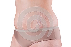 Female belly with stretch marks isolated on white background