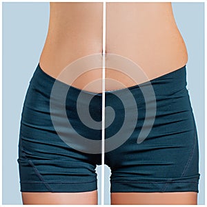Female body before and after liposuction. Plastic surgery and weight loss